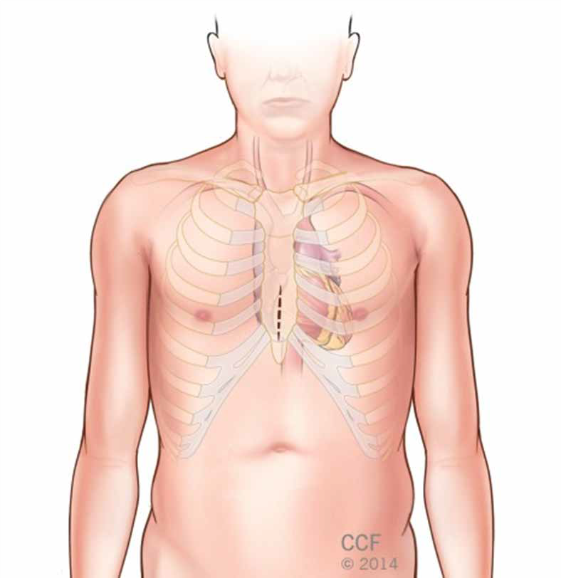 minimally invasive and robotically assisted heart surgery 2.png